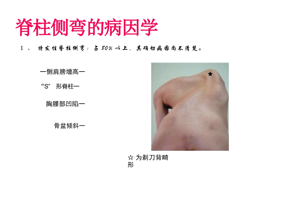 脊柱侧弯的诊断及治疗一_第4页