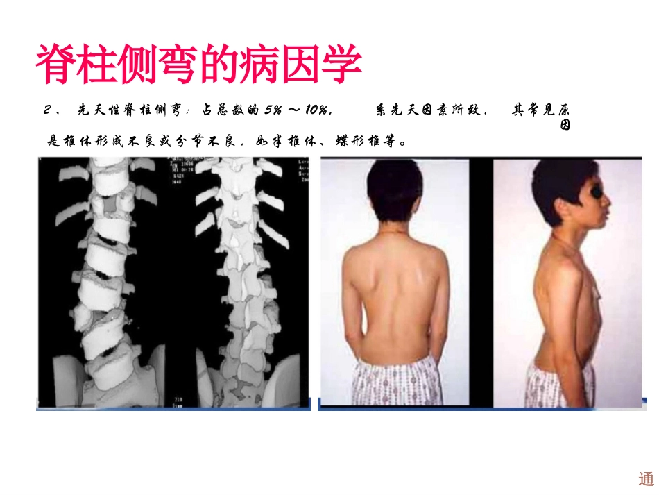 脊柱侧弯的诊断及治疗一_第5页