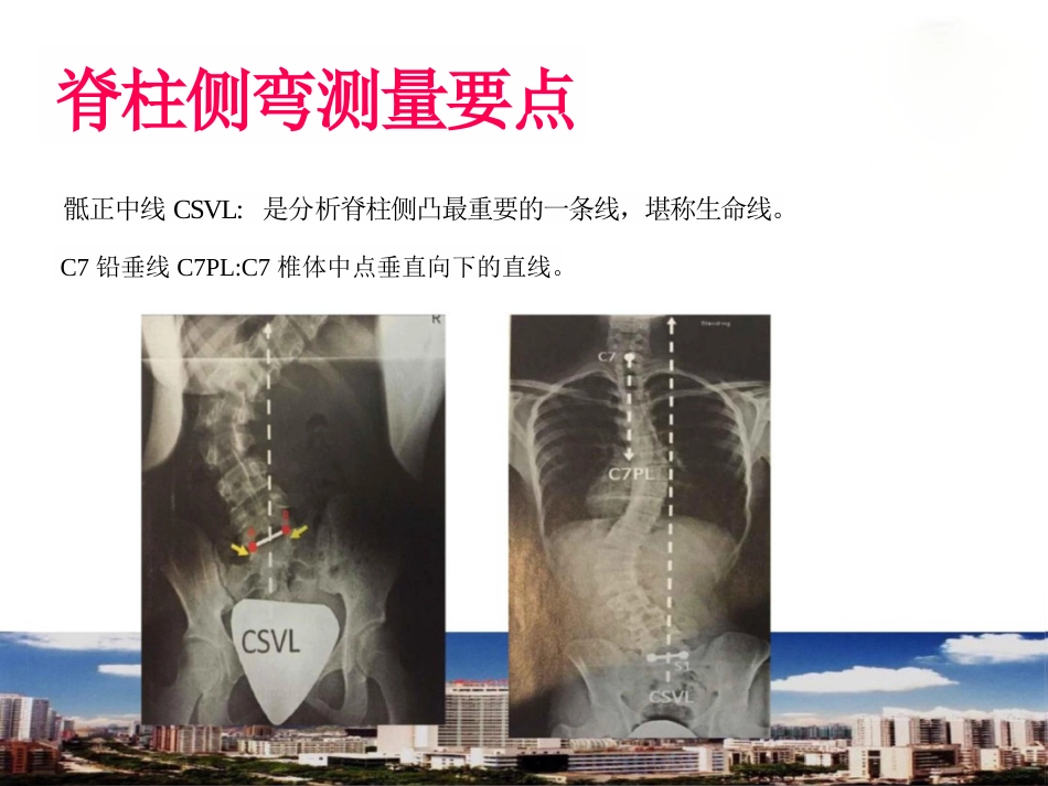 脊柱侧弯的诊断及治疗一_第9页