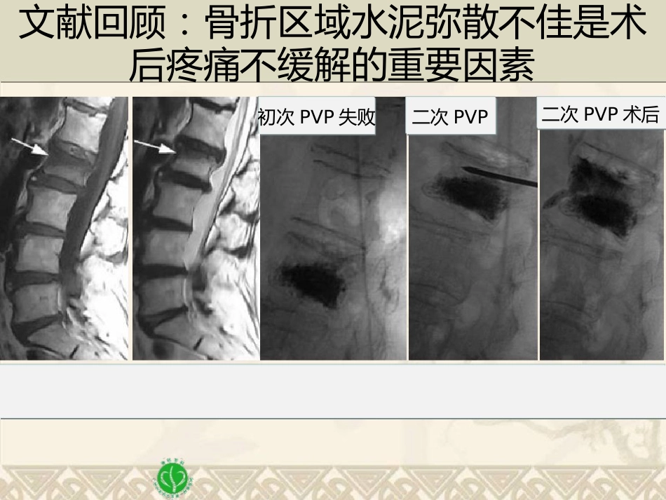 精准椎体成形术_第10页