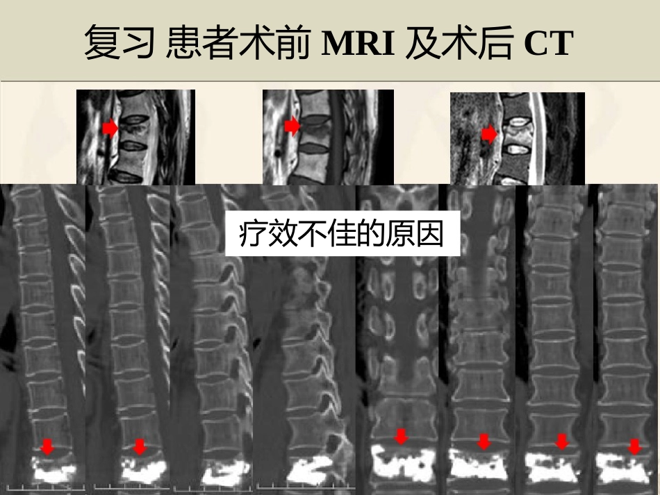 精准椎体成形术_第11页