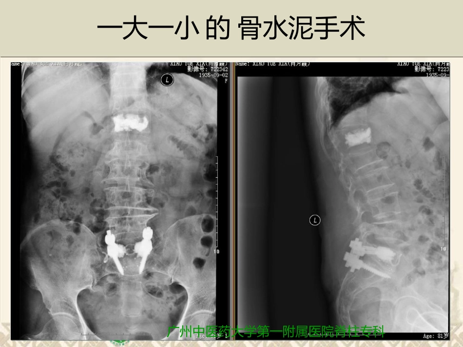 精准椎体成形术_第2页