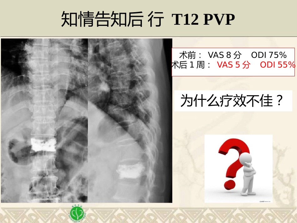 精准椎体成形术_第8页