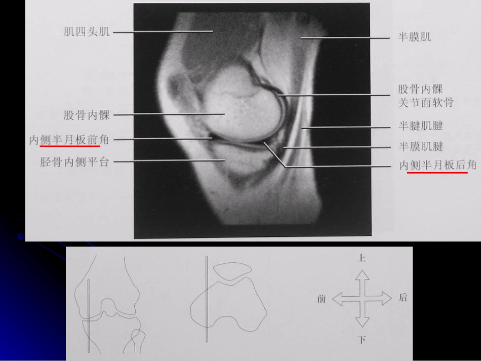 膝关节解剖及MRI诊断_第12页