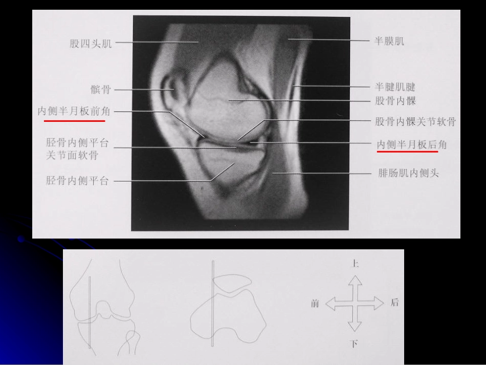 膝关节解剖及MRI诊断_第13页