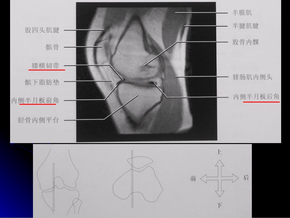 膝关节解剖及MRI诊断_第14页
