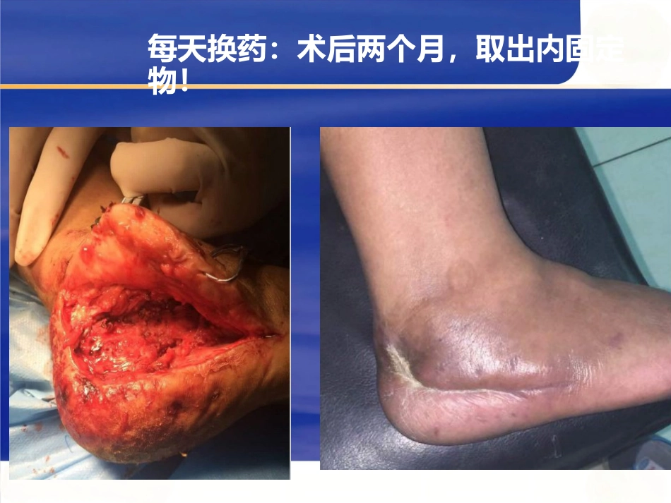 微创跟骨骨折_第10页