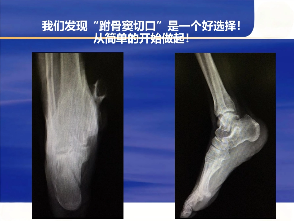 微创跟骨骨折_第13页