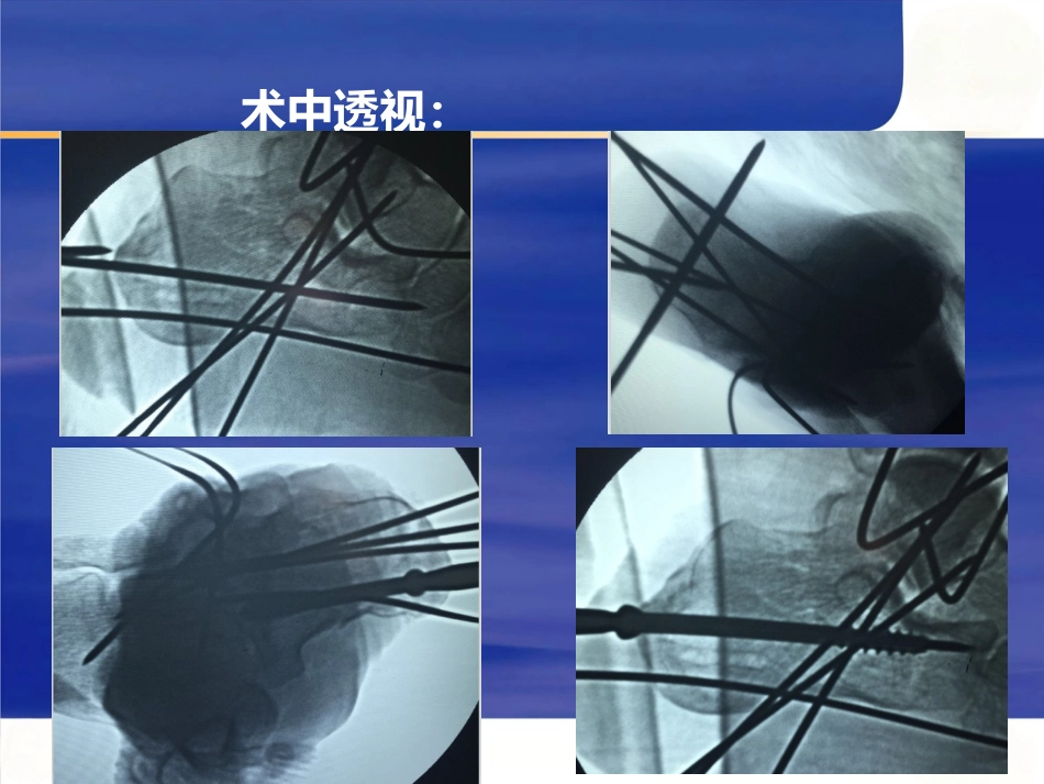 微创跟骨骨折_第15页