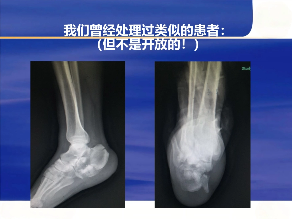 微创跟骨骨折_第6页