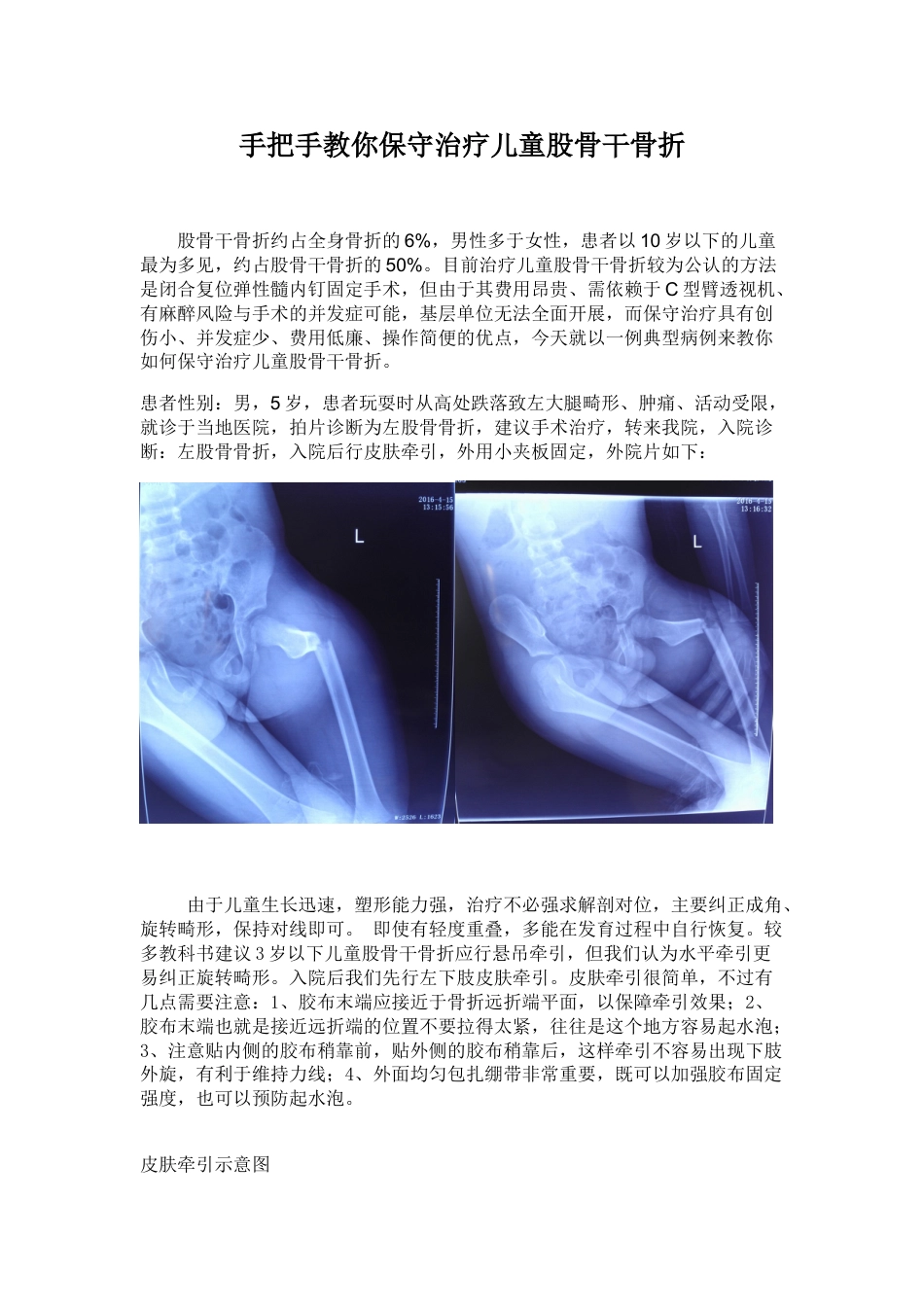 手把手教你保守治疗儿童股骨干骨折_第1页