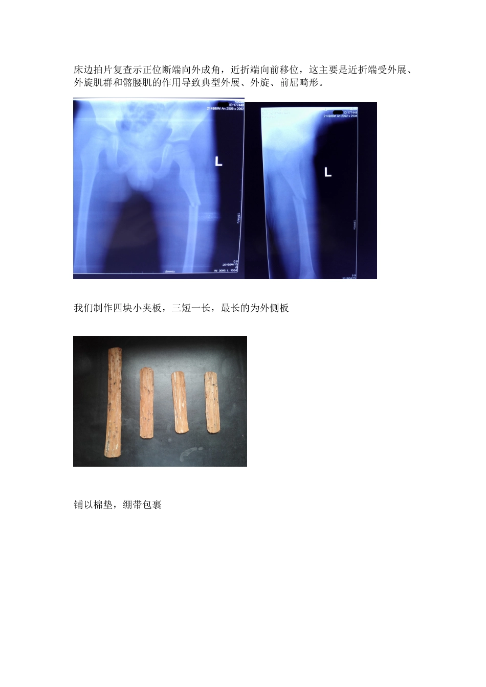 手把手教你保守治疗儿童股骨干骨折_第3页