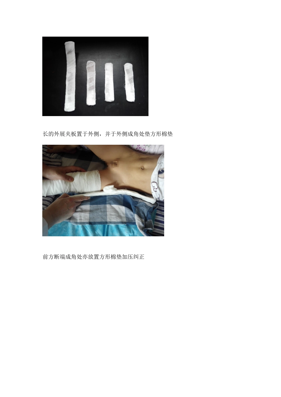 手把手教你保守治疗儿童股骨干骨折_第4页