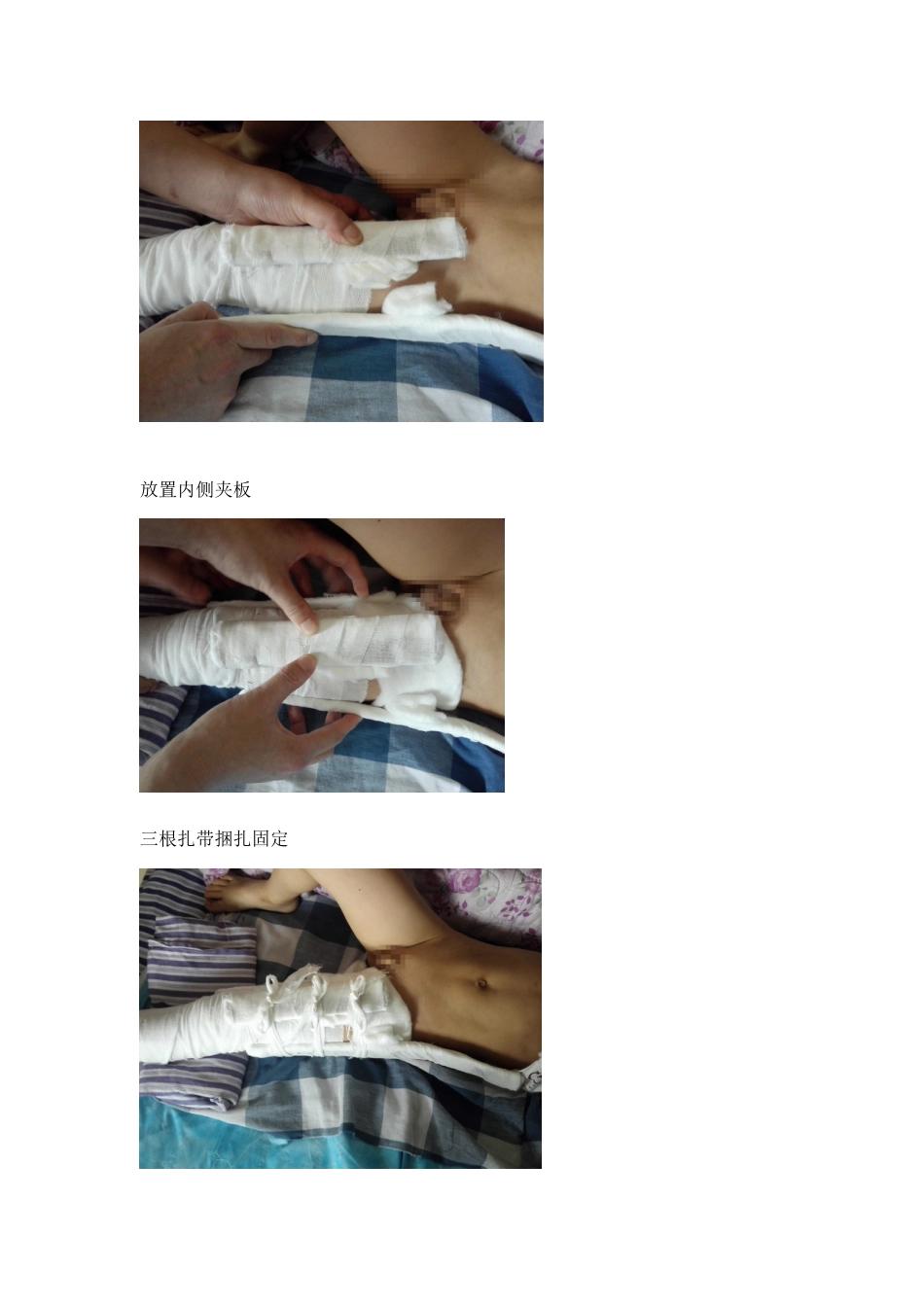 手把手教你保守治疗儿童股骨干骨折_第5页