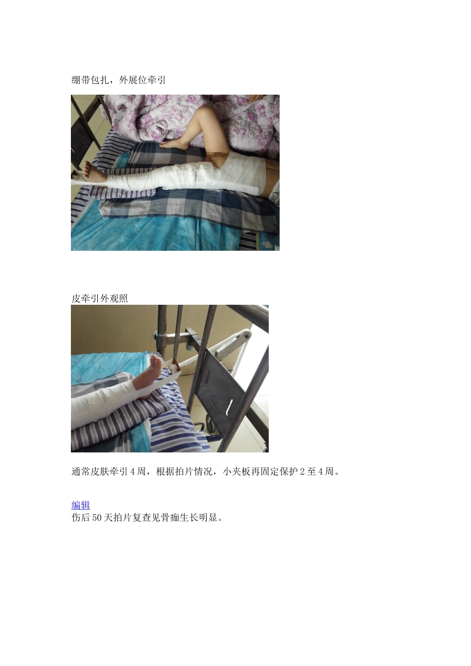 手把手教你保守治疗儿童股骨干骨折_第6页