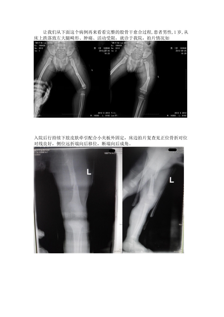 手把手教你保守治疗儿童股骨干骨折_第8页