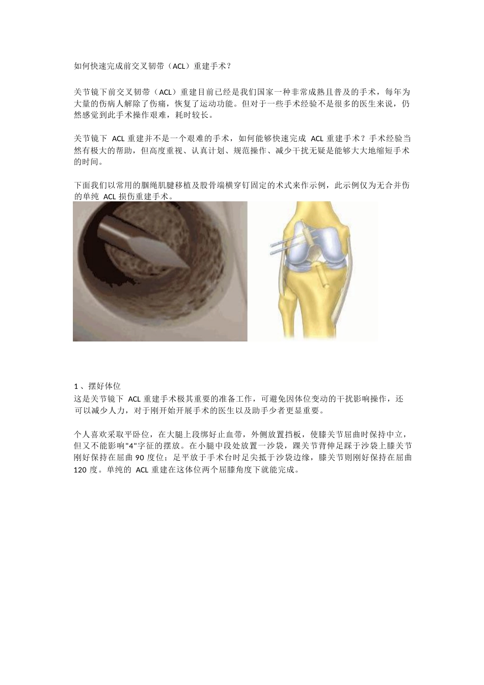 前交叉韧带（ACL）重建手术_第1页