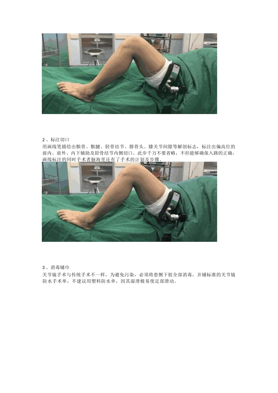 前交叉韧带（ACL）重建手术_第2页
