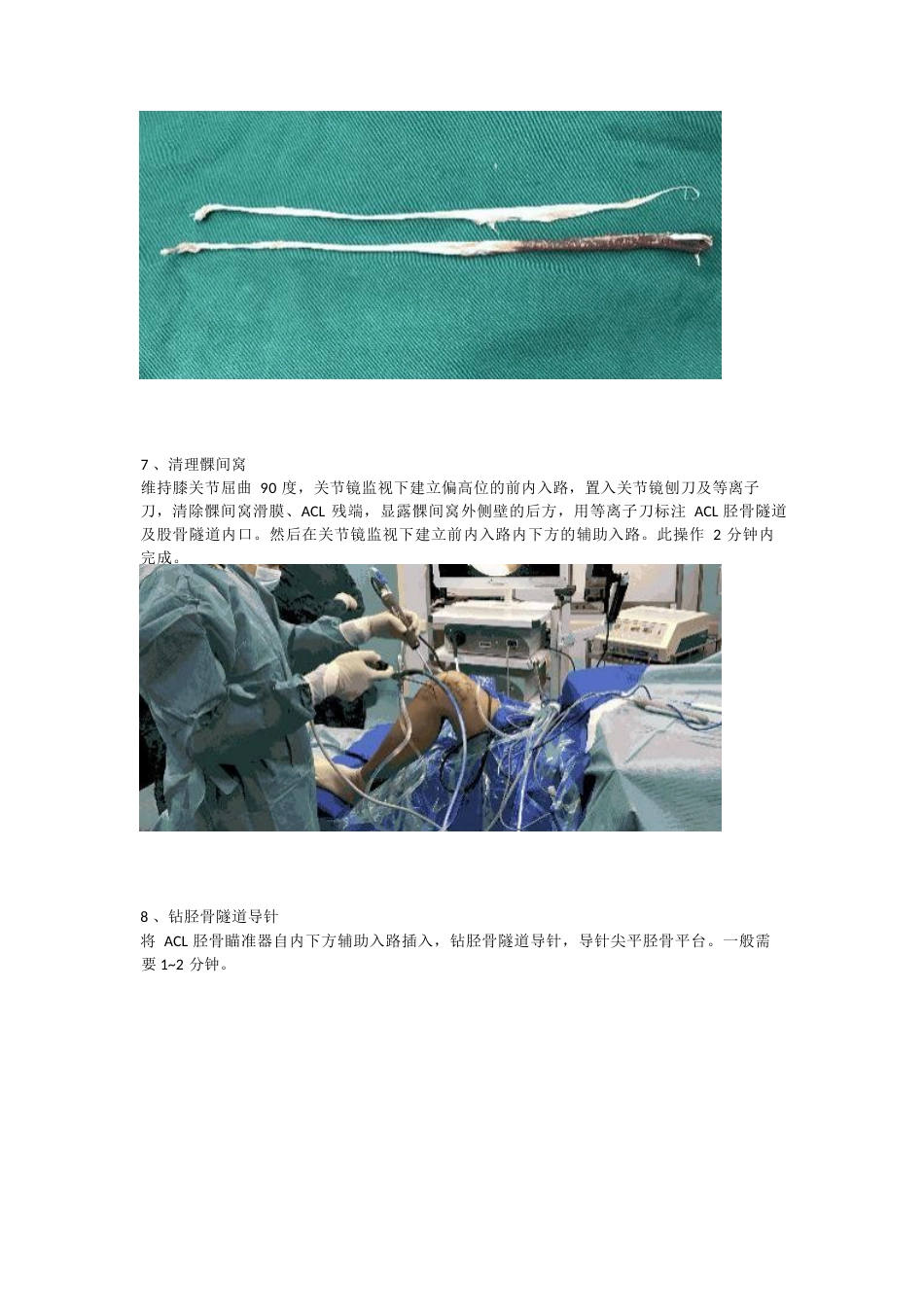 前交叉韧带（ACL）重建手术_第4页