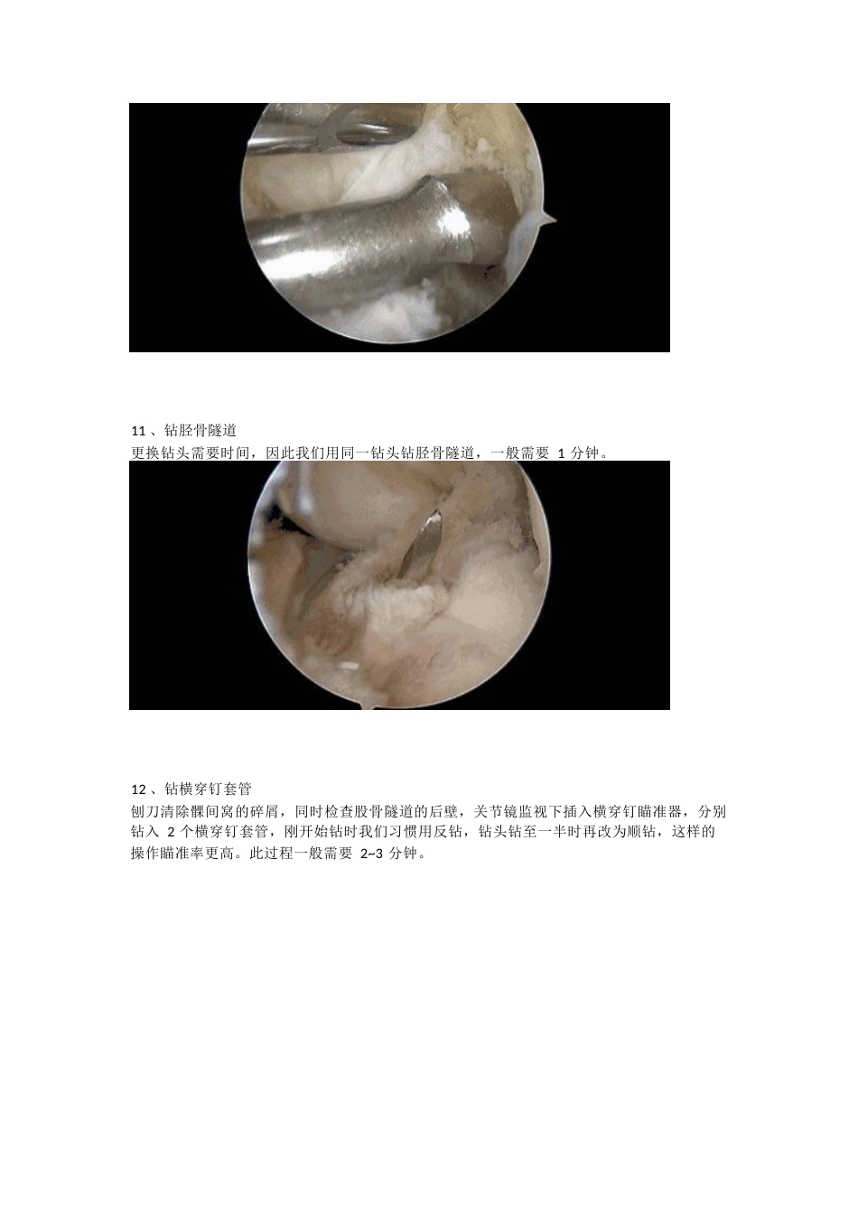 前交叉韧带（ACL）重建手术_第6页