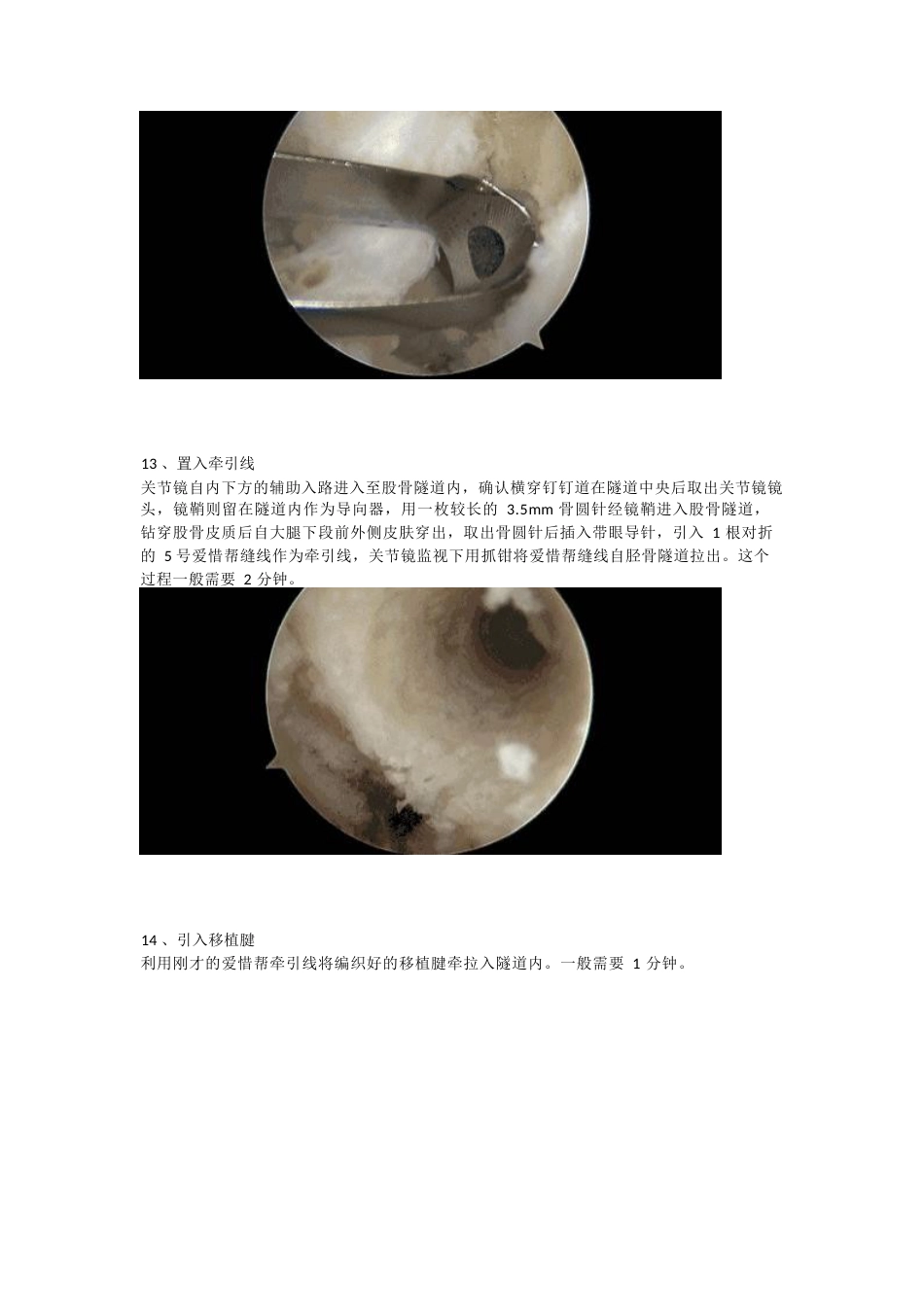 前交叉韧带（ACL）重建手术_第7页