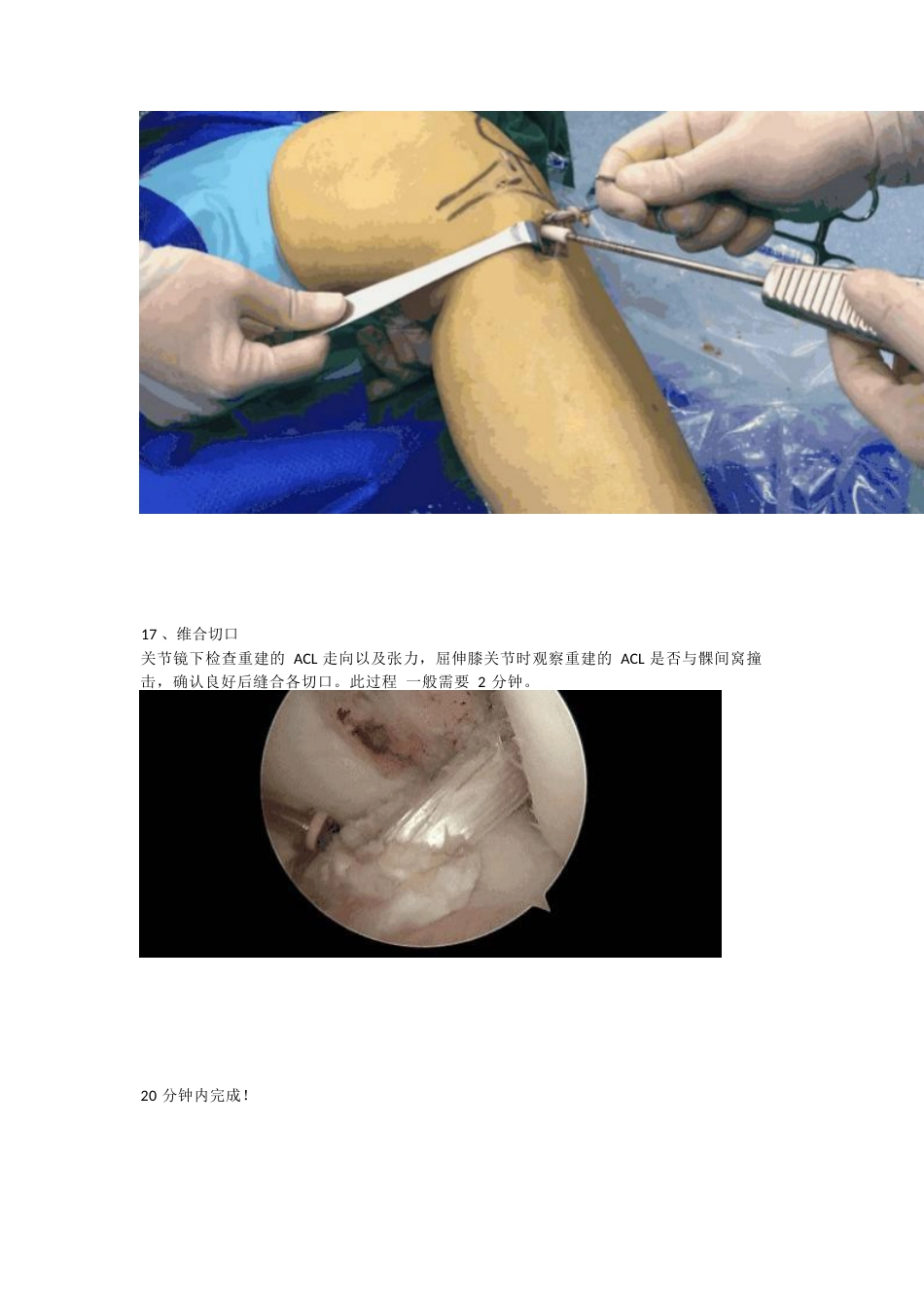 前交叉韧带（ACL）重建手术_第9页