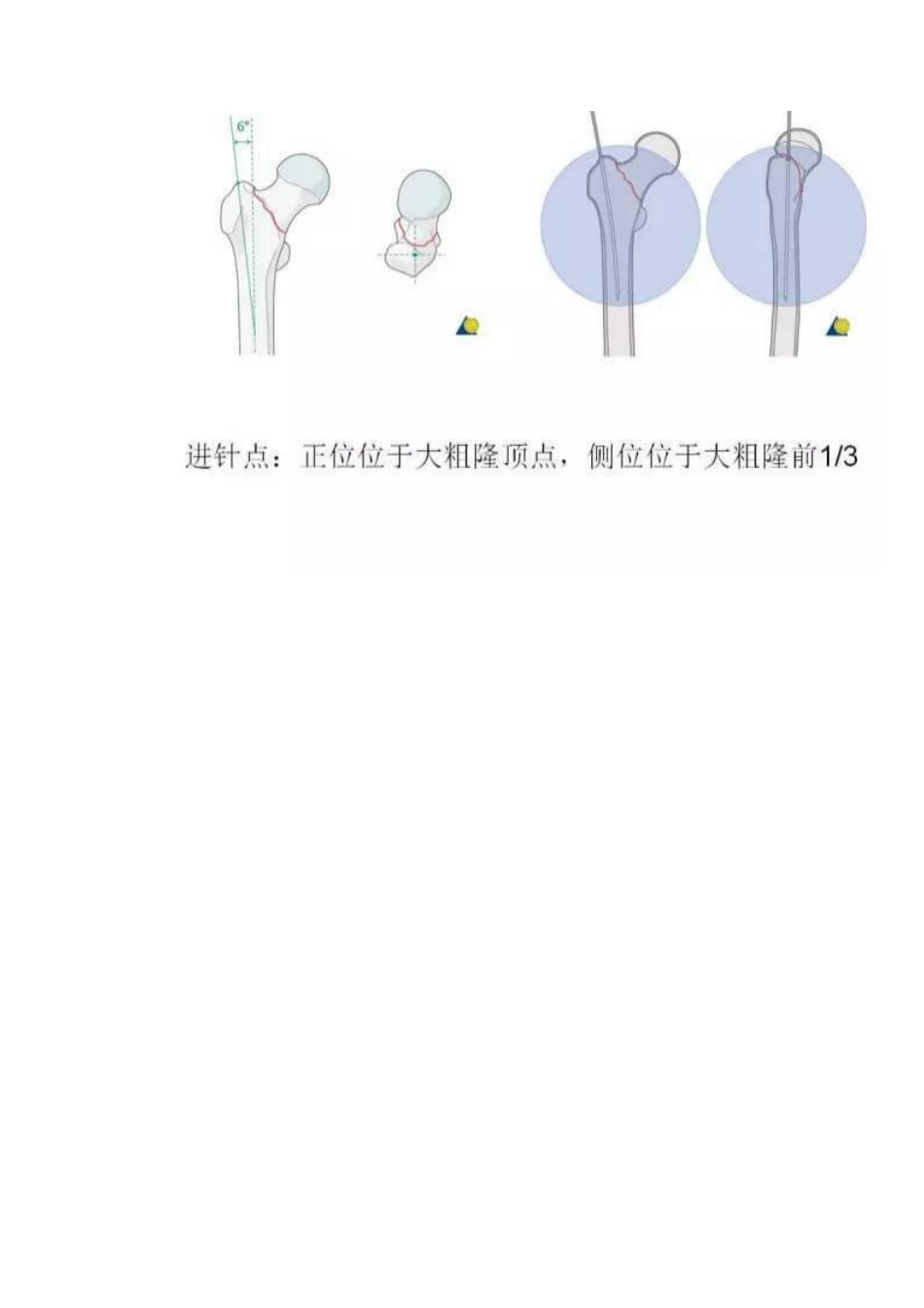 PFN内固定治疗股骨粗隆间骨折_第10页