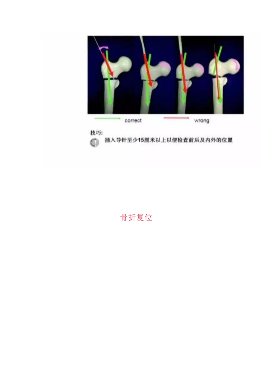 PFN内固定治疗股骨粗隆间骨折_第11页