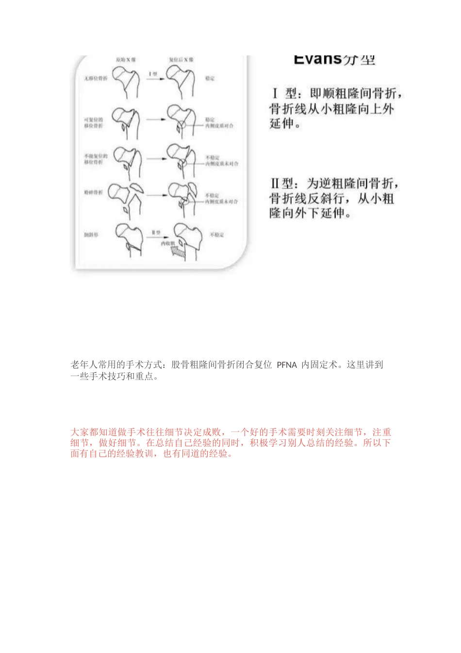 PFN内固定治疗股骨粗隆间骨折_第2页