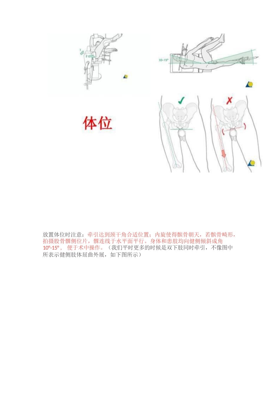 PFN内固定治疗股骨粗隆间骨折_第3页