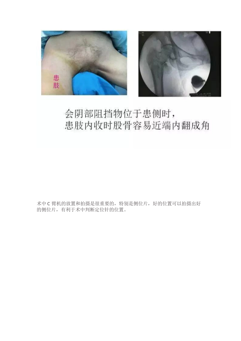 PFN内固定治疗股骨粗隆间骨折_第6页