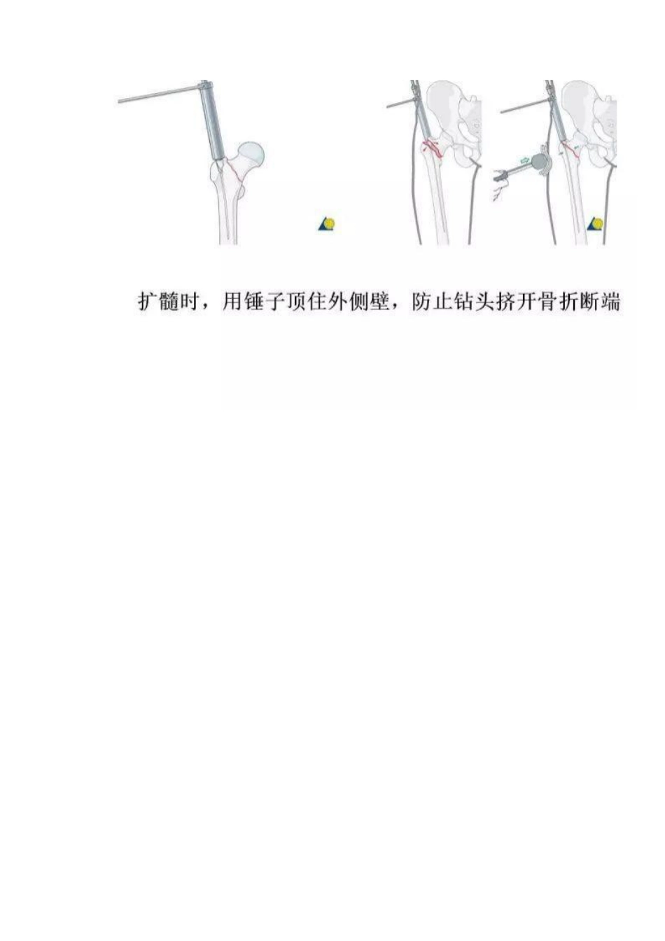 PFN内固定治疗股骨粗隆间骨折_第9页