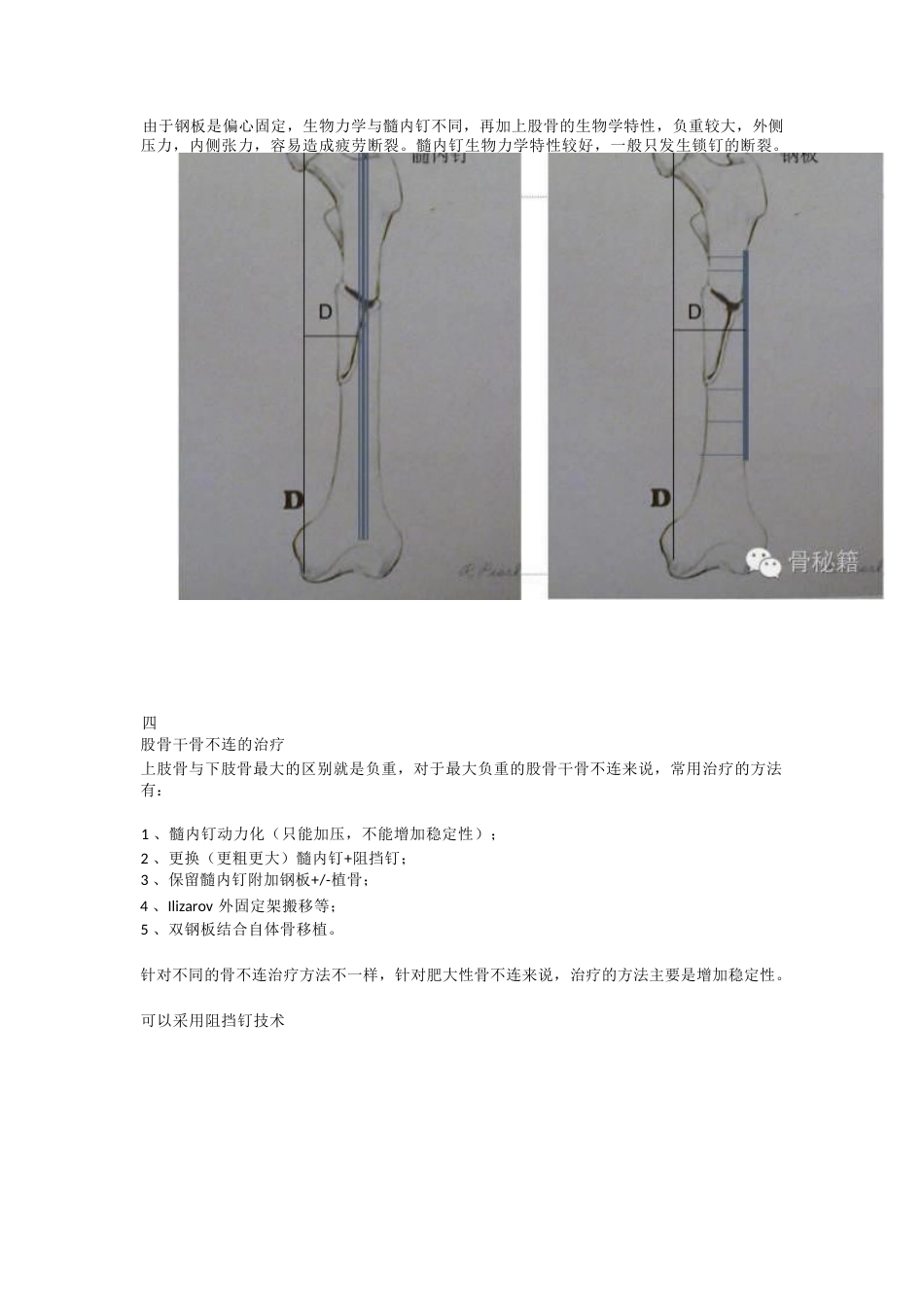 股骨干骨不连的双钢板治疗_第2页