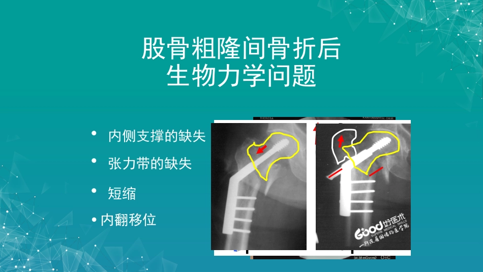 股骨粗隆间骨折若干问题的探讨_第12页