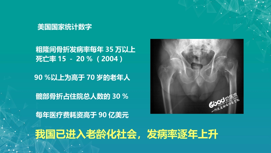 股骨粗隆间骨折若干问题的探讨_第3页