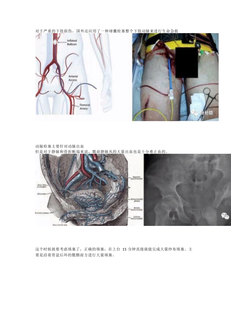 骨盆骨折的急救治疗_第13页