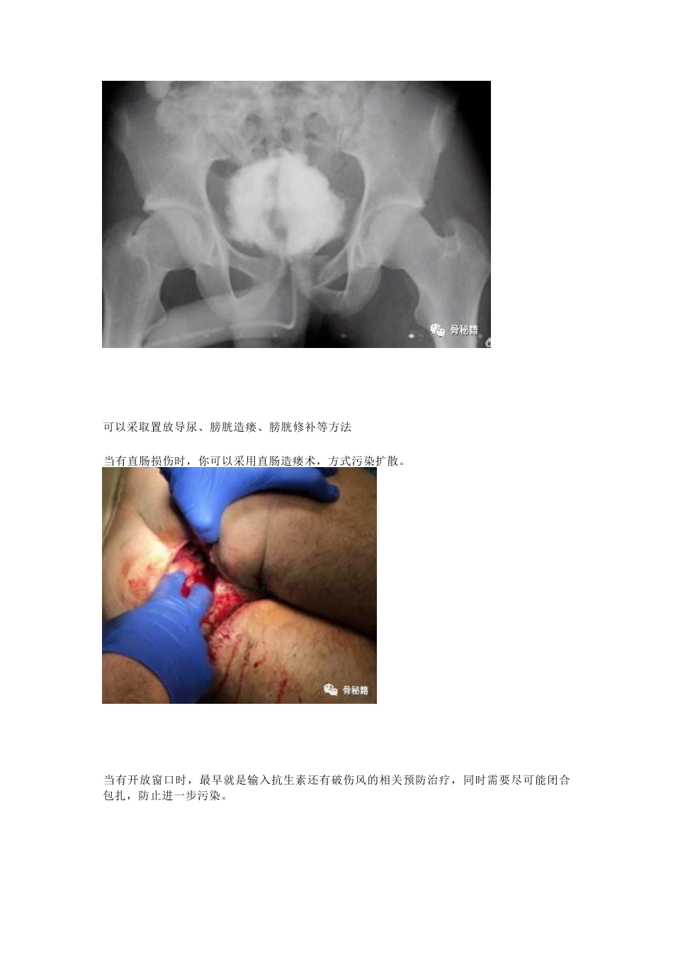 骨盆骨折的急救治疗_第5页