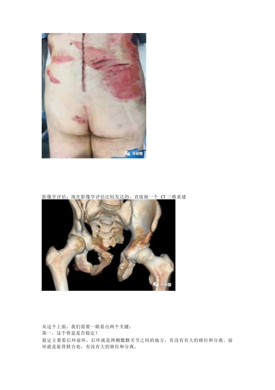 骨盆骨折的急救治疗_第6页