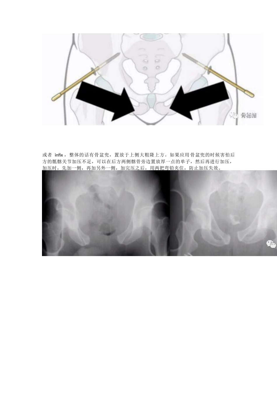 骨盆骨折的急救治疗_第8页