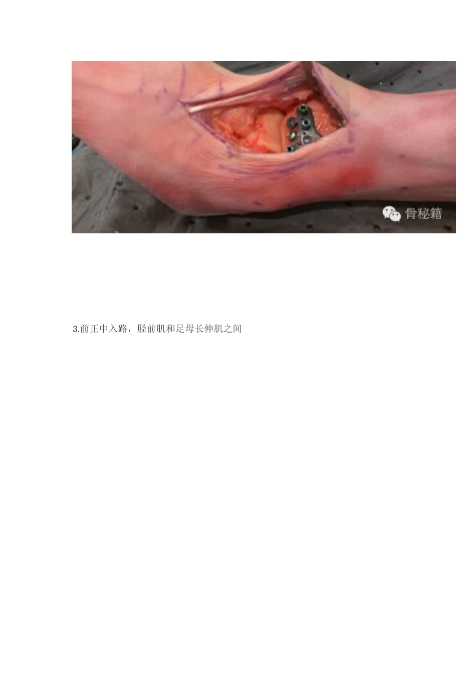 Pilon骨折的手术入路和手术技巧_第10页