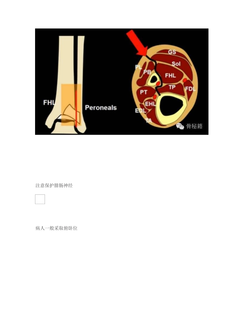 Pilon骨折的手术入路和手术技巧_第14页