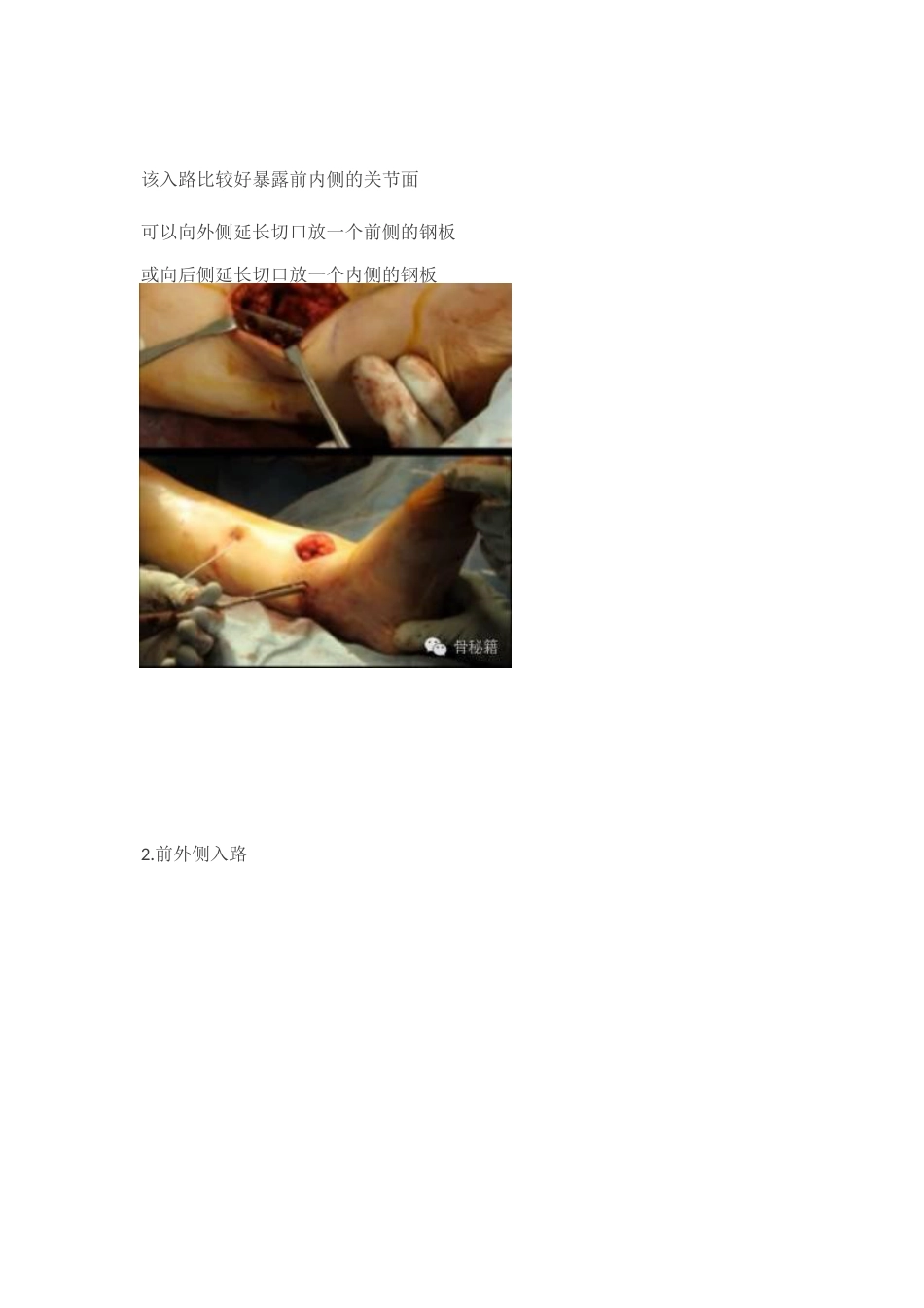 Pilon骨折的手术入路和手术技巧_第7页