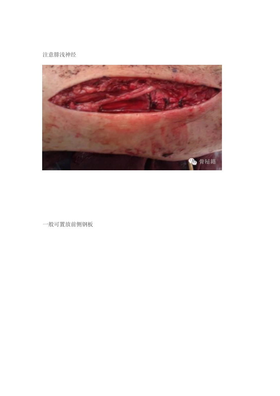 Pilon骨折的手术入路和手术技巧_第9页