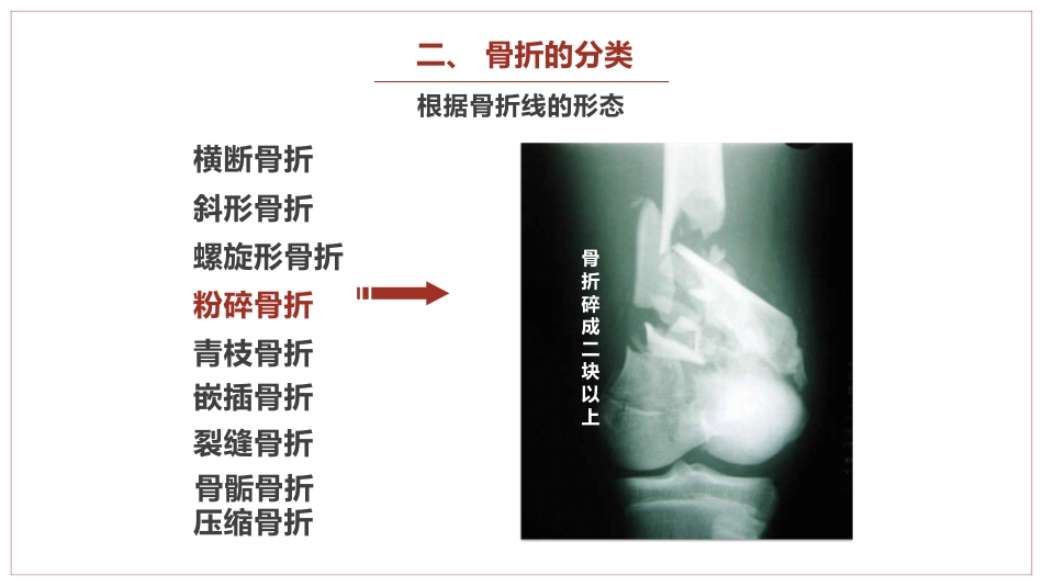 中医骨伤科学骨折概论临床知识学习课件PPT_第10页