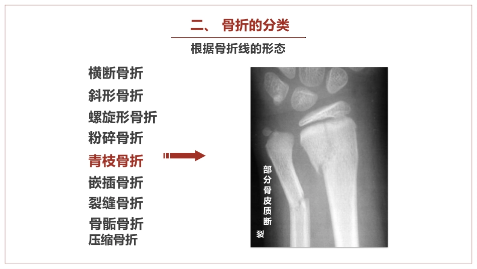 中医骨伤科学骨折概论临床知识学习课件PPT_第11页