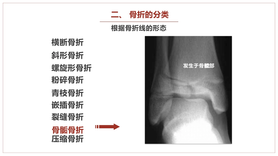 中医骨伤科学骨折概论临床知识学习课件PPT_第14页