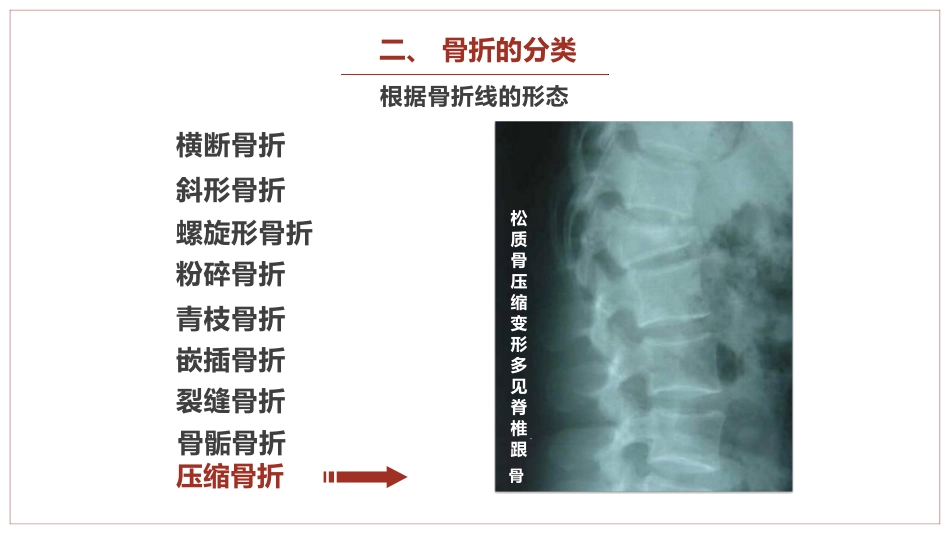 中医骨伤科学骨折概论临床知识学习课件PPT_第15页