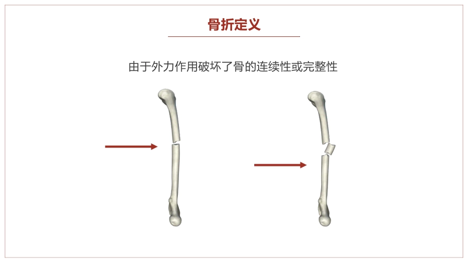 中医骨伤科学骨折概论临床知识学习课件PPT_第2页