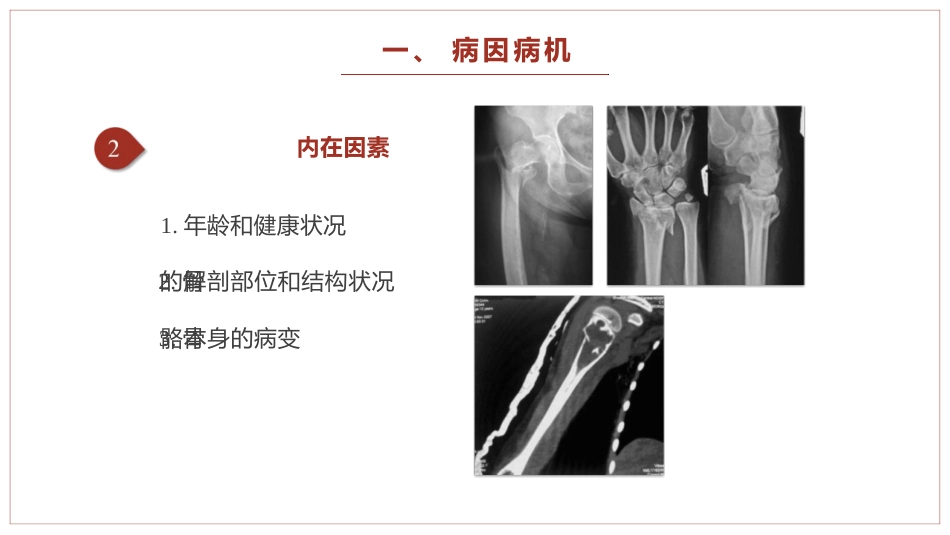 中医骨伤科学骨折概论临床知识学习课件PPT_第5页
