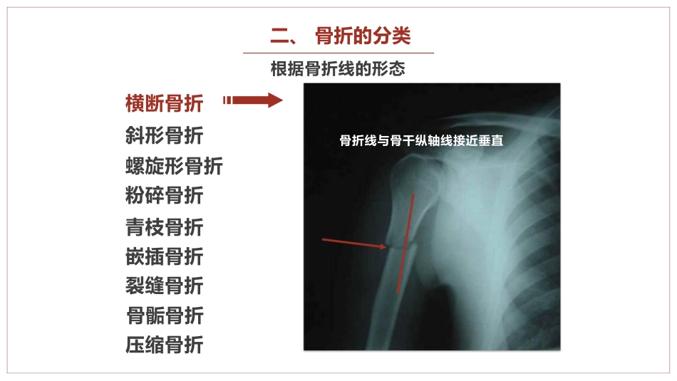 中医骨伤科学骨折概论临床知识学习课件PPT_第7页